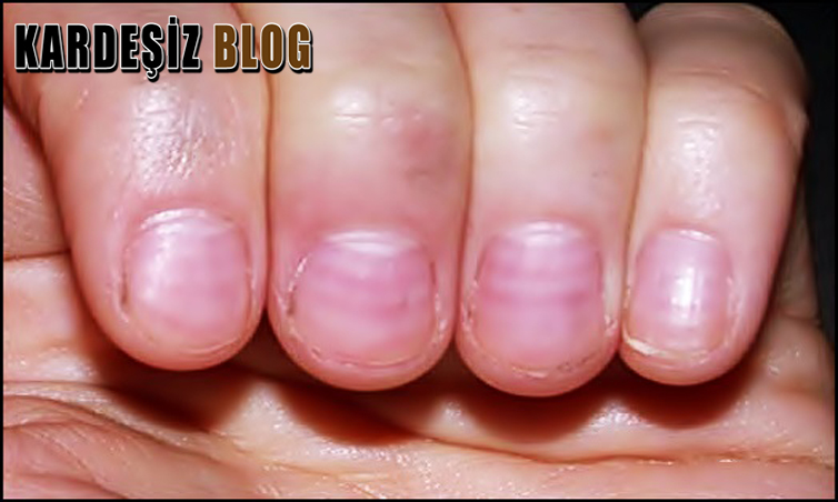 Kaşık Tırnak Ağrı Yapar Mı