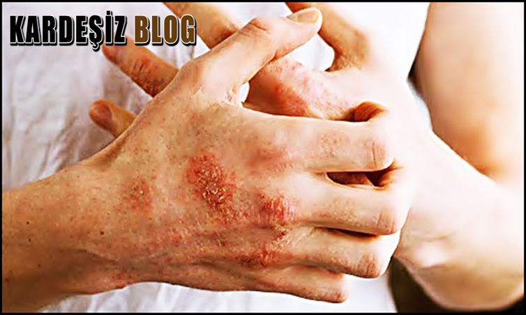 Kolestaz Nasıl Anlaşılır