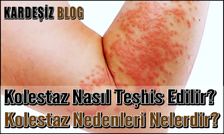 Kolestaz Nasıl Teşhis Edilir