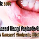 Ağız Kanseri Hangi Yaşlarda Görülür