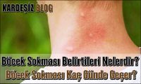 Böcek Sokması Belirtileri Nelerdir