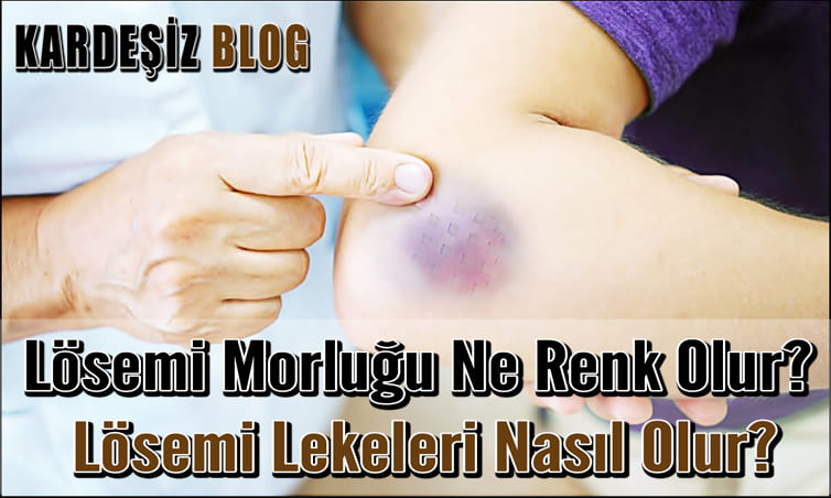 Lösemi Morluğu Ne Renk Olur