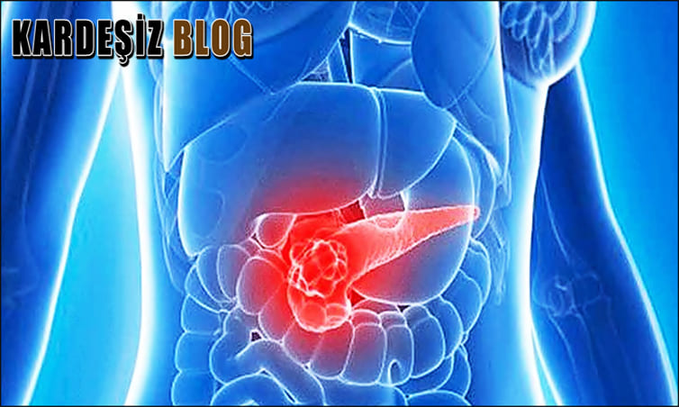 Pankreas Kanseri Kemoterapi ile iyileşir Mi