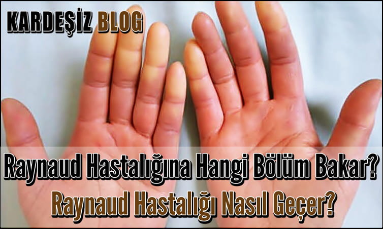 Raynaud Hastalığına Hangi Bölüm Bakar