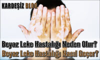 Beyaz Leke Hastalığı Neden Olur