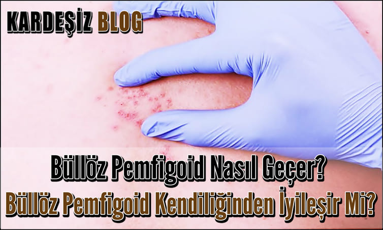 Büllöz Pemfigoid Nasıl Geçer