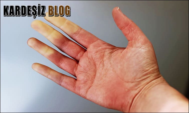 Büllöz Pemfigoid Yapan ilaçlar Nelerdir