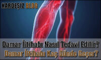 Damar iltihabı Nasıl Tedavi Edilir