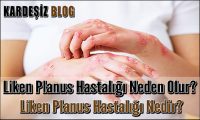 Liken Planus Hastalığı Neden Olur