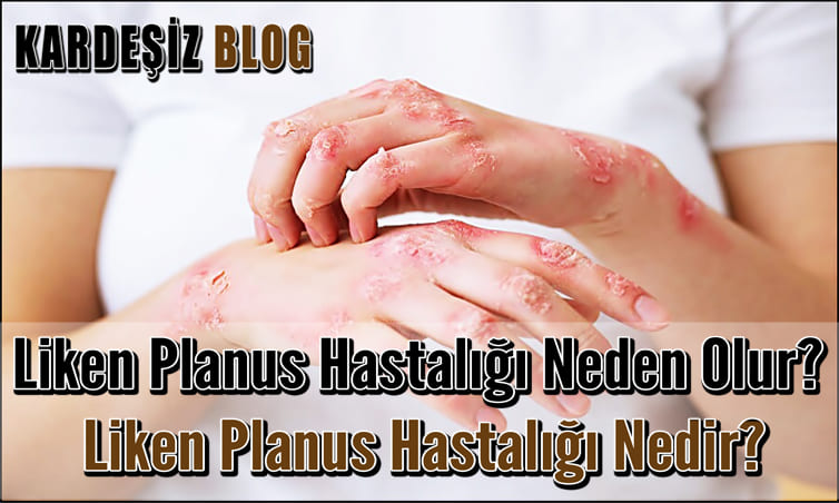 Liken Planus Hastalığı Neden Olur