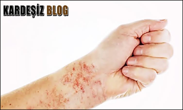 Liken Planus Kaç Yılda Geçer