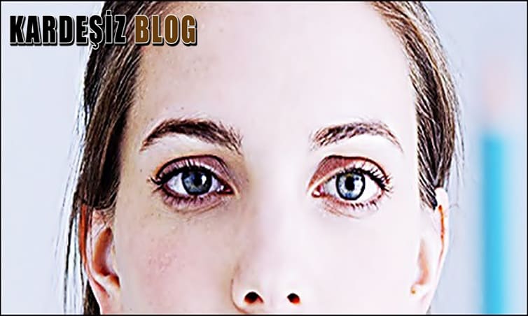 Göz Kayması Sonradan Düzelir Mi