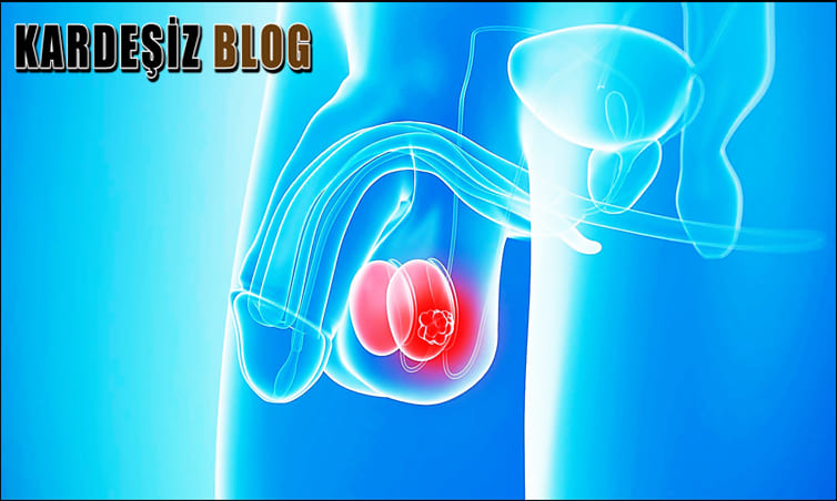 Testis Kanseri Elle Hissedilir Mi