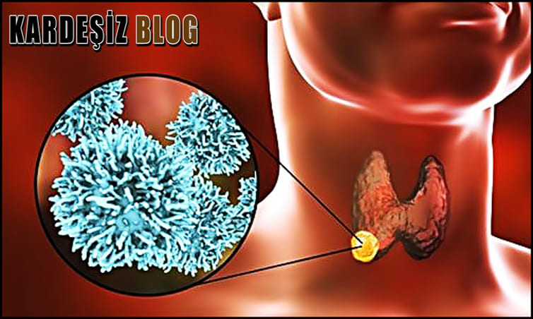 Tiroid Ameliyatı Tehlikeli Midir