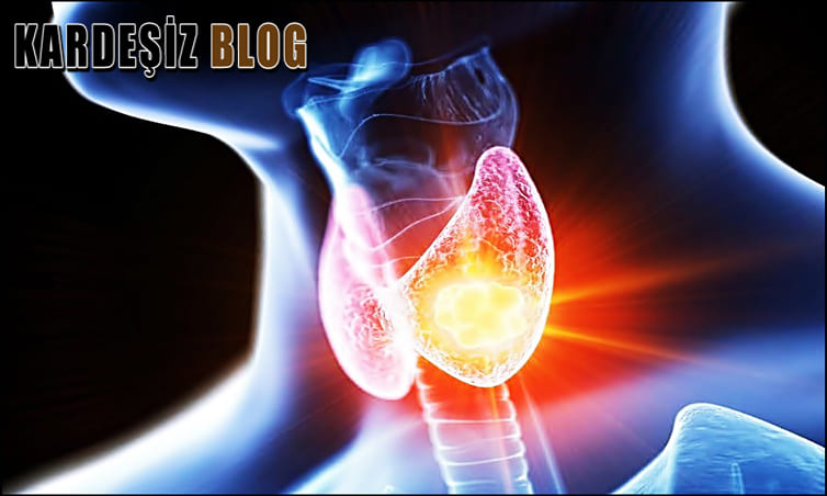 Tiroid Nodülü Stresten Olur Mu