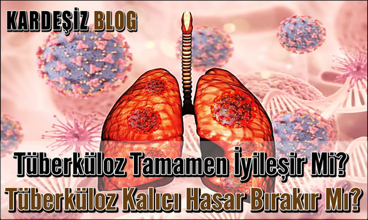 Tüberküloz Tamamen iyileşir Mi