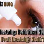 Uveit Hastalıgı Belirtileri Nelerdir