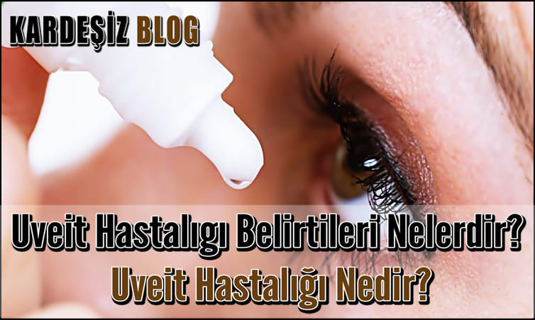 Uveit Hastalıgı Belirtileri Nelerdir
