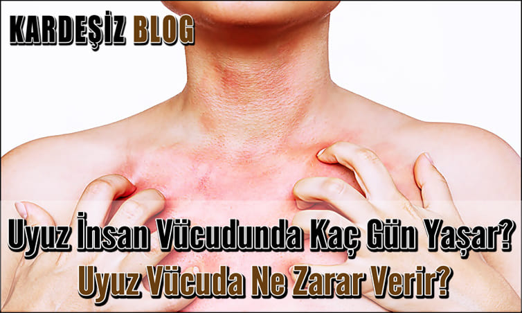Uyuz insan Vücudunda Kaç Gün Yaşar