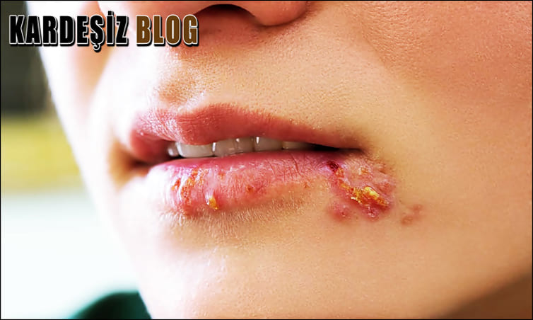 Uçuk Acısı Ne Zaman Geçer