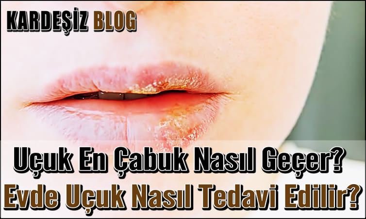 Uçuk En Çabuk Nasıl Geçer