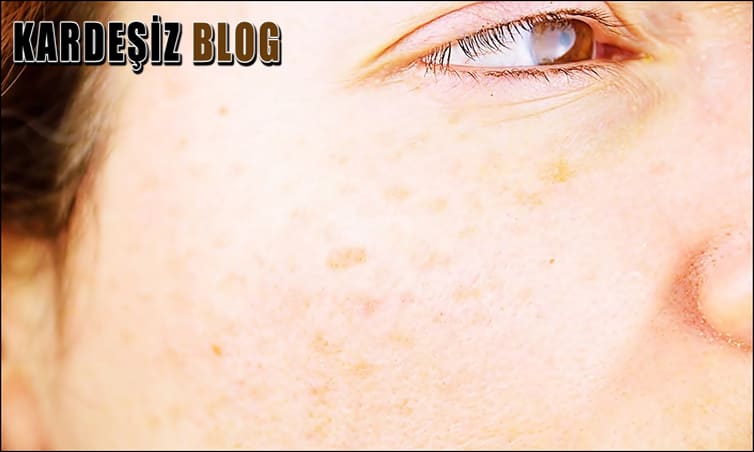 Yüzdeki Kahverengi Lekeler Hangi Vitamin Eksikliğinden Olur