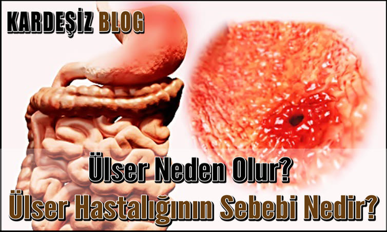 Ülser Neden Olur