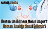 Üretra Daralması Nasıl Geçer