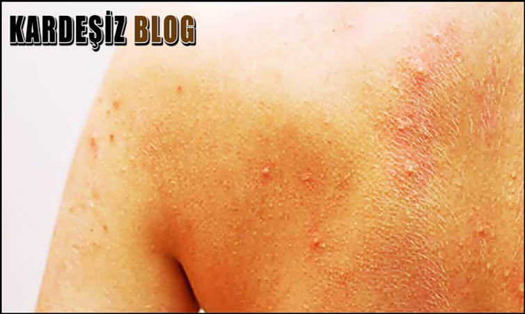 VDRL Testi Sonucu Ne Kadar Sürede Çıkar