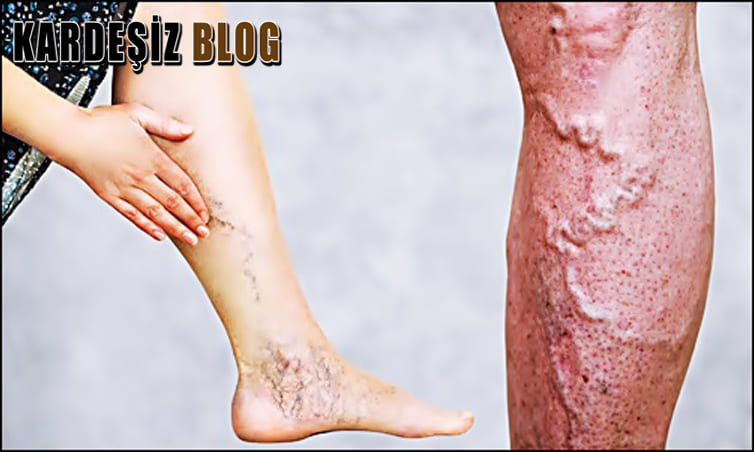 Venöz Yetmezlik Nasıl Anlaşılır