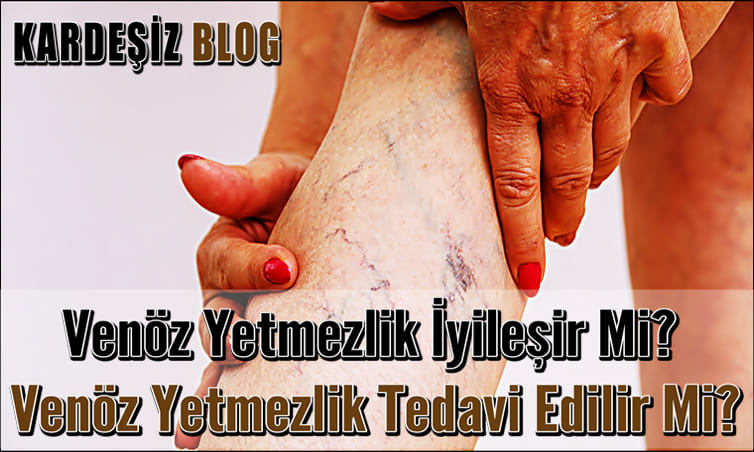 Venöz Yetmezlik iyileşir Mi