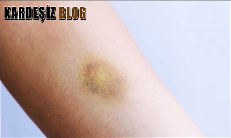 Vücutta Aniden Oluşan Morluklar Neden Olur