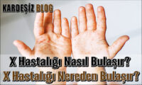 X Hastalığı Nasıl Bulaşır