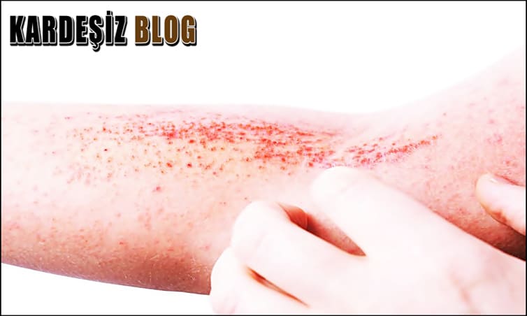 Yılancık Hastalığı Kaç Günde iyileşir