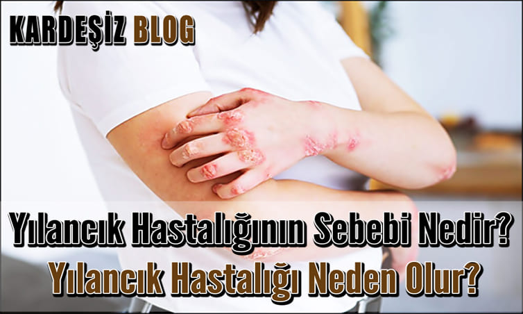 Yılancık Hastalığının Sebebi Nedir