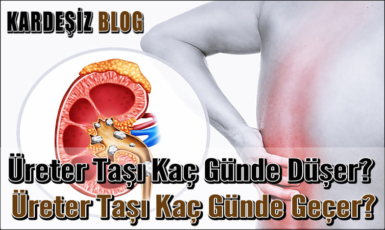 Üreter Taşı Kaç Günde Düşer