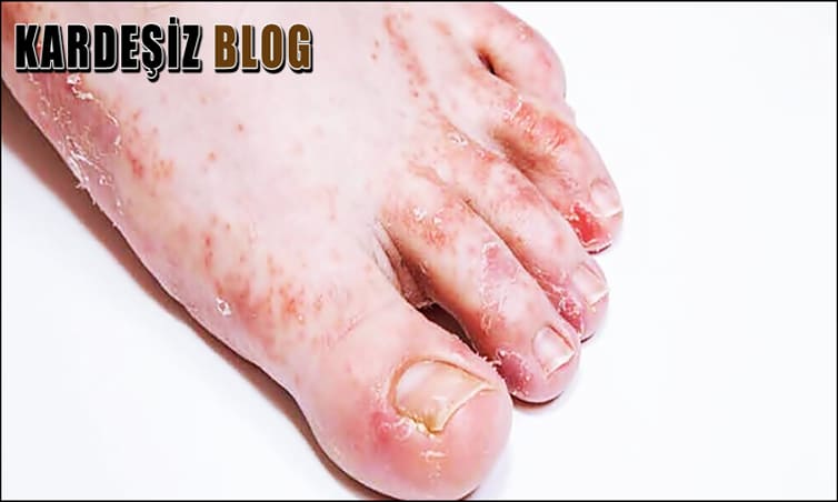 Ayak Mantarı Hangi Vitamin Eksikliğinden Olur