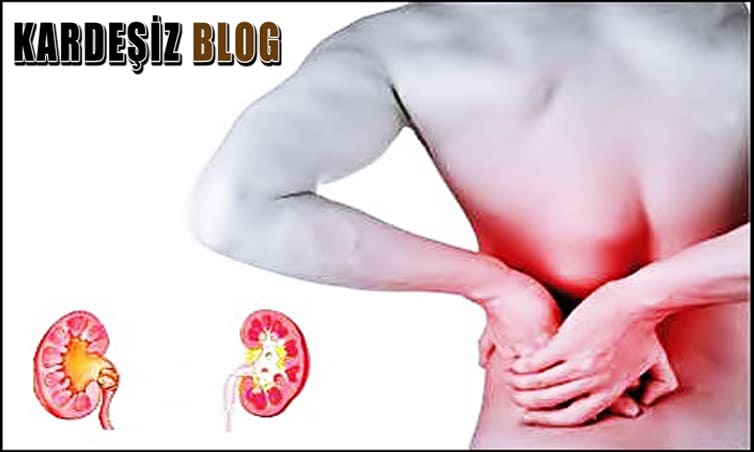 Böbrek Taşı Ağrısına Ne iyi Gelir Evde