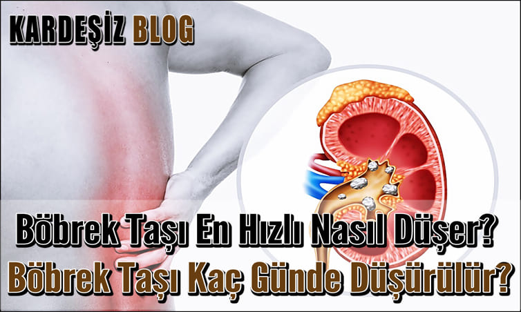 Böbrek Taşı En Hızlı Nasıl Düşer