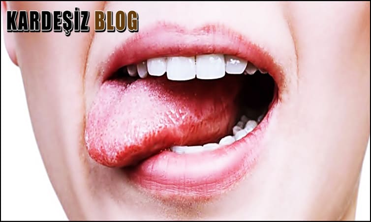 Dil Yarası Stresten Olur Mu